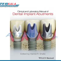 Dental Implants Abutments