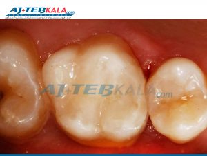 تراش سطح اکلوزال