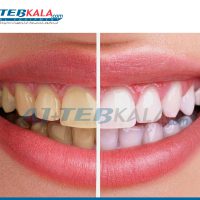سه عامل تغییر رنگ در دندان ها